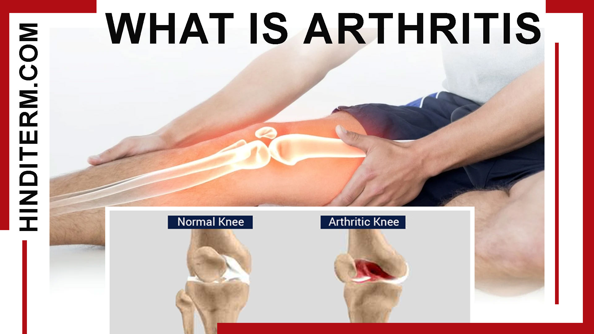 आर्थराइटिस क्या और क्यों होता है, तथा किसकी कमी से होता है?