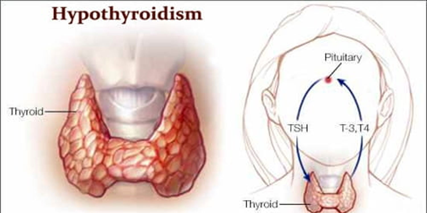 Hypothyroidism in hindi