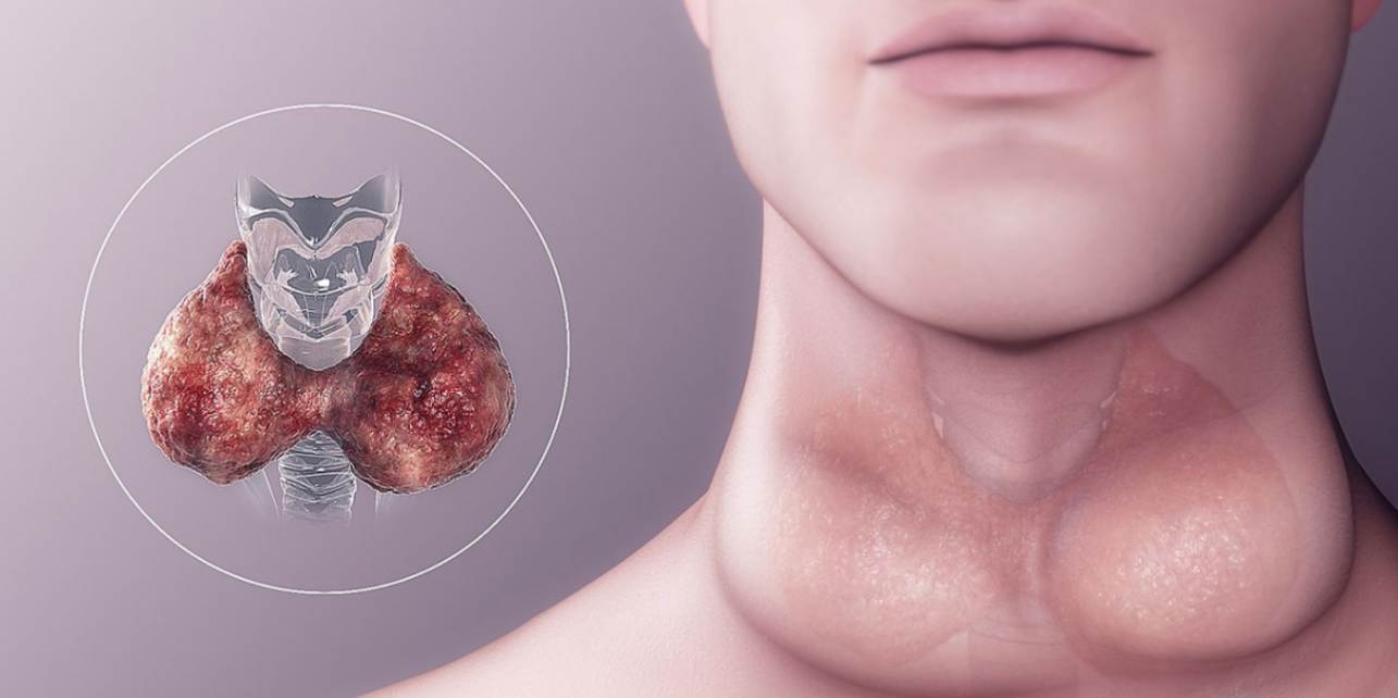 Hypothyroidism क्या है, इसका इलाज, लक्षण, रोकथाम और आहार