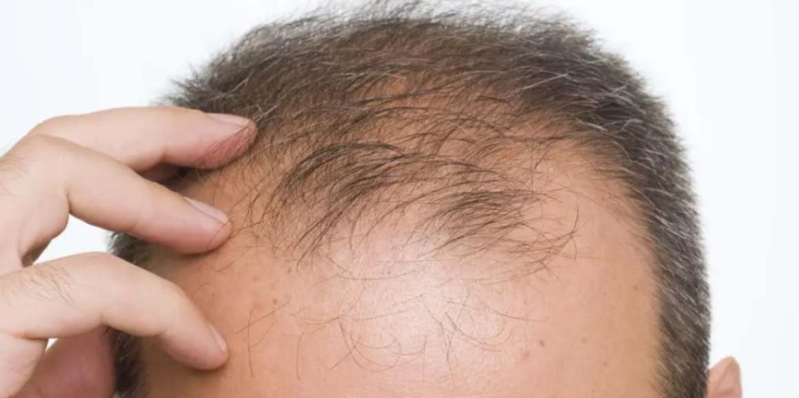 Hair Loss Treatment