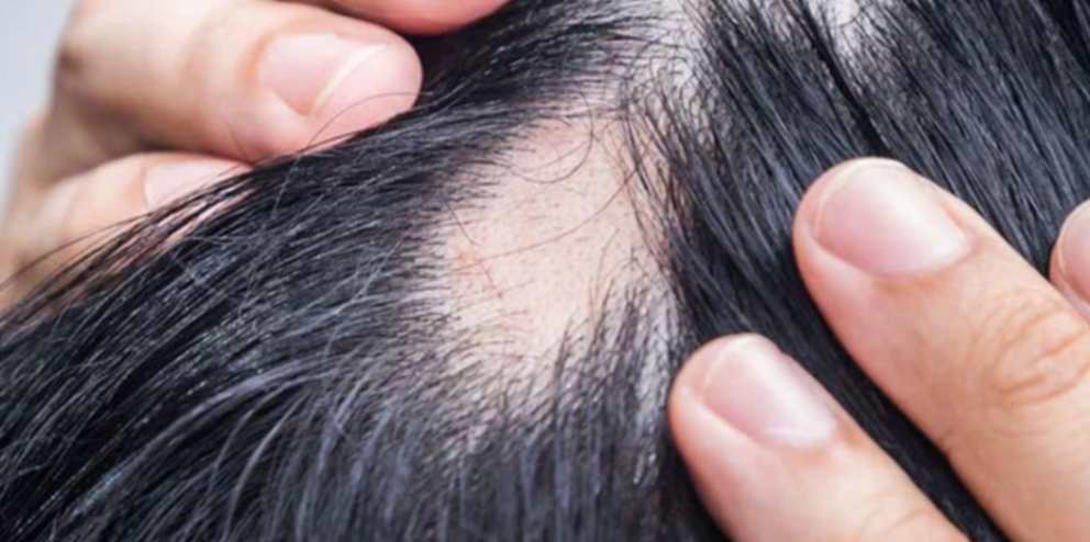 Hair Fall Symptoms