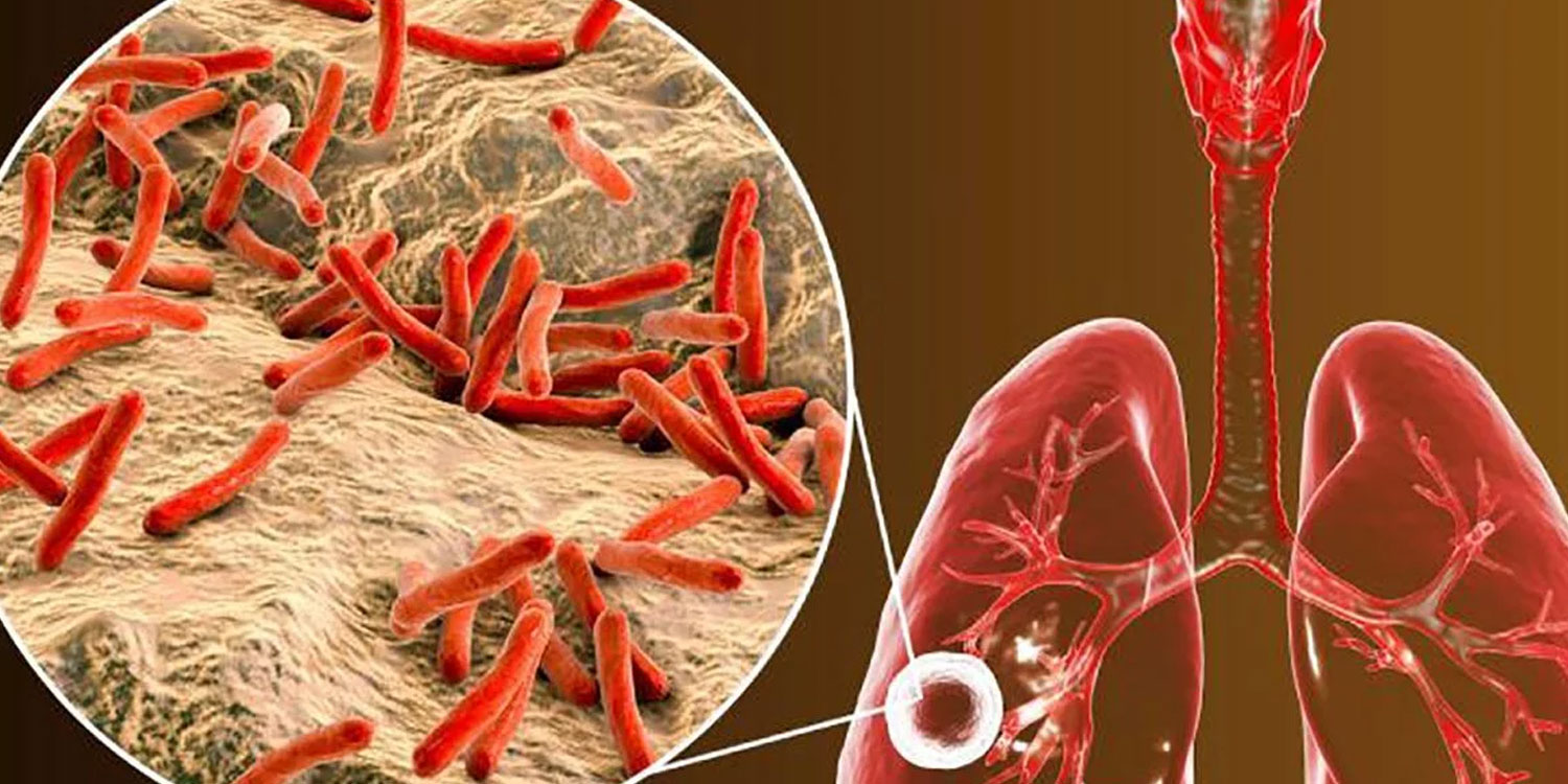 Tuberculosis-TB Causes