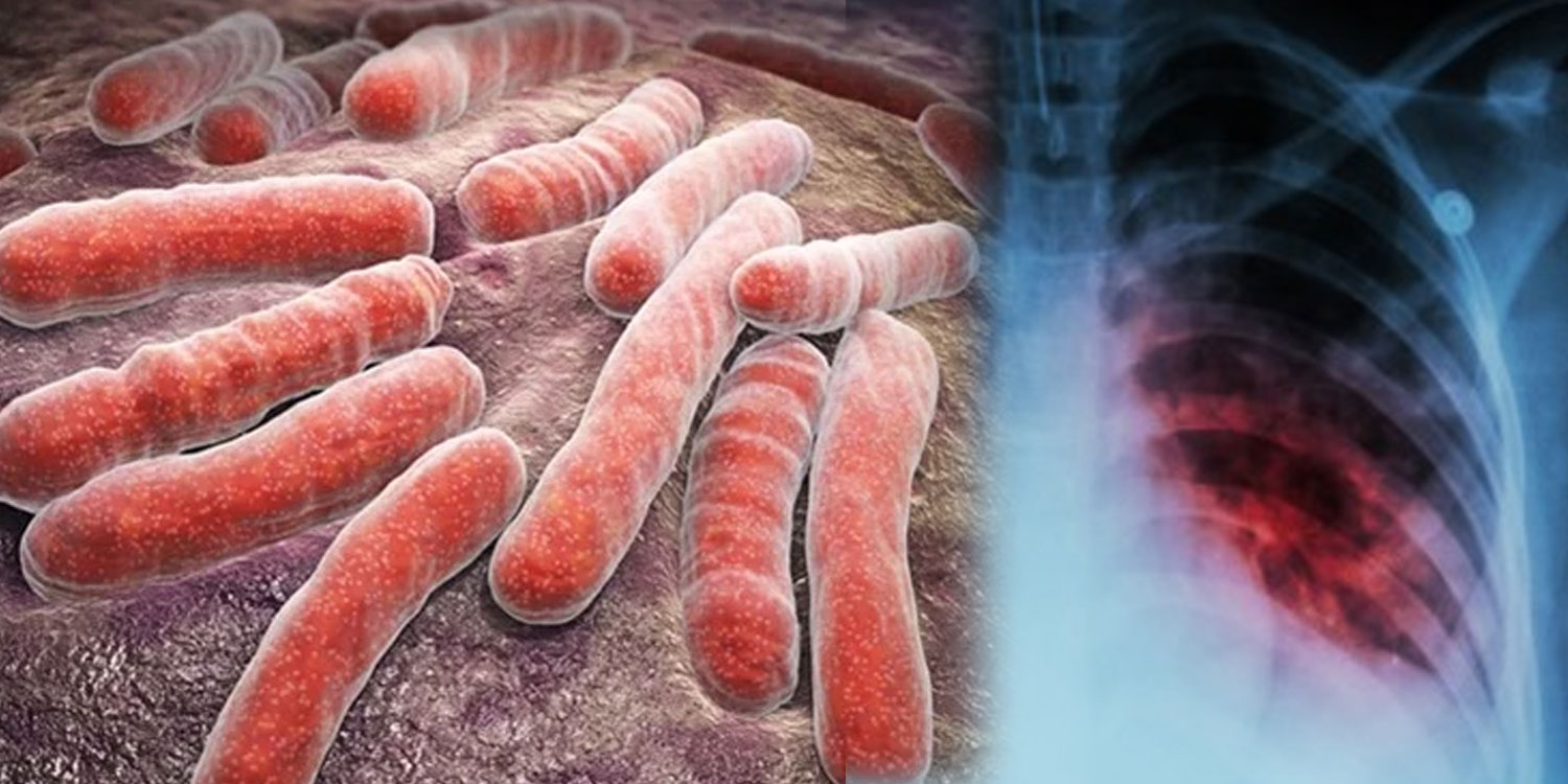 Tuberculosis TB Preventation