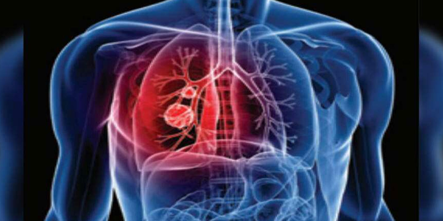 Tuberculosis-TB के मामले दुनिया भर में पहली बार इस साल में बढ़ा