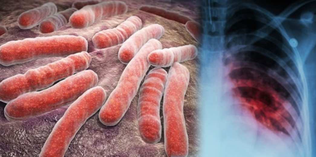 Tuberculosis TB Preventation